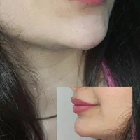 تزریقات تخصصی فیلر و بوتاکس|خدمات آرایشگری و زیبایی|مسجد سلیمان, |دیوار