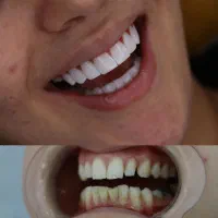 کامپوزیت تخفیف