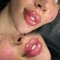 ژل‌بوتاکس(فیلرلب‌گونه‌چونه‌سیب‌گونه‌)اف‌عیدانه