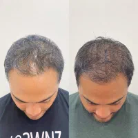 قبل از کاشت موهاتو پس بگیر