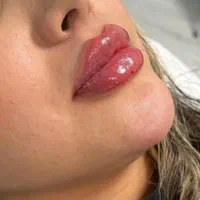 تزریق ژل و بوتاکس در کلینیک