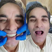 دندان مصنوعی،لمینتی جوان پسند،سبک جدید، نسل جدید|خدمات زیبایی و سلامت|مشهد, شاهد (شهرک غرب)|دیوار