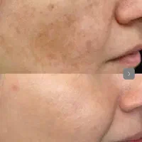 کرم ضدلک و روشن کننده ،جای جوش ..)