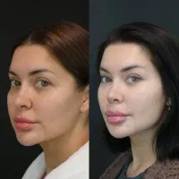 فستیوال زیبایی  شرایط ویژه جراحی بینی