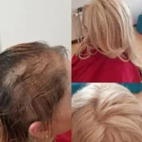 پروتز مو طبیعی  آقایون و بانوان