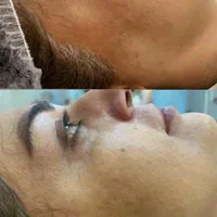 آموزش فشیال صورت. پاکسازی تخصصی و مدل پاکسازی پوست|خدمات آرایشگری و زیبایی|رشت, معلم|دیوار