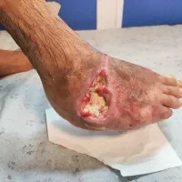 درمان تخصصی زخم بستر