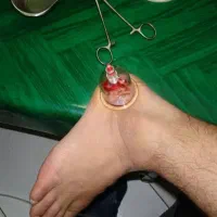 طب حجامت و زالو درمانی