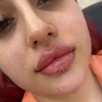 ژل لب و بوتاکس لیفت ابرو