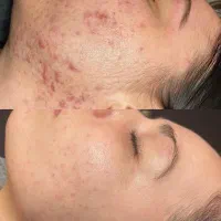 تکنیک پوست کره ای