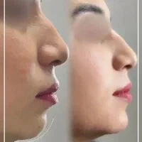 تزریق ژل لب،بوتاکس،مزو تراپی،هایفو تراپی،لیزر|خدمات آرایشگری و زیبایی|فردیس, شهرک ارم|دیوار