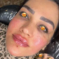 offویژه تزریق فیلروبوتاکس برای خانم‌هاوآقایان
