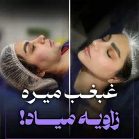 ساکشن غبغب بلفارو کاشت ابرو بوکال فت|خدمات آرایشگری و زیبایی|تهران, میرداماد|دیوار
