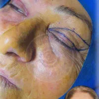 جشنواره ویژه بلفاروپلاستی(جراحی زیبایی پلک)|خدمات آرایشگری و زیبایی|دیلم, |دیوار