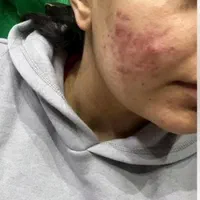 درمان جوش با هر منشایی|خدمات آرایشگری و زیبایی|دوگنبدان, |دیوار