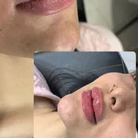 ژل و بوتاکس ۶۹۰