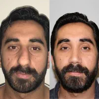 رینو جراحی عمل زیبایی بینی چربی لیپو سانترال پلک|خدمات آرایشگری و زیبایی|تهران, ونک|دیوار
