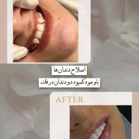 جشنواره کامپوزیت دندان فقط با۵ میلیون(نقد و اقساط)|خدمات آرایشگری و زیبایی|تهران, فردوس|دیوار