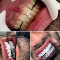 کامپوزیت دندان|خدمات آرایشگری و زیبایی|آبادان, |دیوار