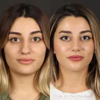 عمل زیبایی بینی (قسطی)|خدمات آرایشگری و زیبایی|تهران, مطهری|دیوار