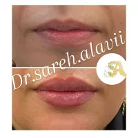 جشنواره تخفیف تزریق فیلر لب به مدت محدود توسط پزشک|خدمات آرایشگری و زیبایی|قم, دورشهر|دیوار