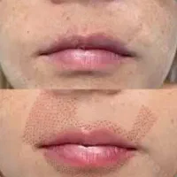 پلاسما رفع چروک صورت وپلک وکوچک کردن بینی