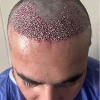 جشنواره ویژه کاشت تخصصی موشیرازی ۸میلیون باضمانت|خدمات زیبایی و سلامت|تهران, پاسداران|دیوار