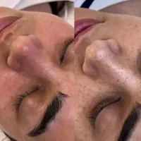 درمان پوست ،فیشال،شبه لیزر،پوست کره ای،پاکسازی