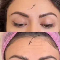 مدل برای فیلر و بوتاکس فقط هزینه موادگرفته میشود|خدمات زیبایی و سلامت|کرج, گلشهر|دیوار