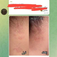 جای جوش و لک صورت و ....با ما برطرف کن|آرایشی، بهداشتی، درمانی|شیراز, دانشگاه شیراز|دیوار