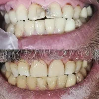 دندانپزشکی کشیدن کامپوزیت عصب کشی پرکردن ترمیم|خدمات زیبایی و سلامت|تهران, افسریه شمالی|دیوار