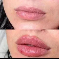 تزریق ژل بوتاکس فیلر مزو و...