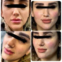 تزریق ژل و بوتاکس و مزوتراپی/ژل لب M تکنیک|خدمات آرایشگری و زیبایی|مشهد, نیروی هوایی|دیوار