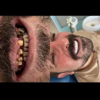 جشنواره دندانپزشکی کامپوزیت لمینت