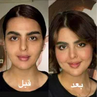 تخفیفات ۵۰٪ژلوبوتاکس وفیلر بادی هایفو توسط پزشک