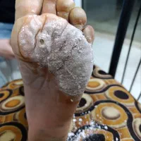 برداشتن خال زیگیل ومیخچه دست پابامحلول گیاهی