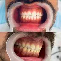 کامپوزیت دندان ودندانسازی ودنداپزشکی|خدمات آرایشگری و زیبایی|بندرعباس, |دیوار