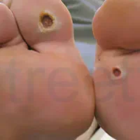 بهبودی تضمینی دیابت