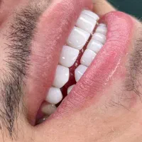 مدل کامپوزیت دندان|خدمات آرایشگری و زیبایی|تهران, هاشمی|دیوار