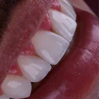 ارتودنسی تعرفه دولتی (طرف قرارداد با بیمه)