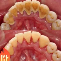 جرمگیری تخصصی فکی ۱ میلیون