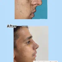 عمل بینی بندرعباس،اقساطی،باکیفیت و تضمین|خدمات آرایشگری و زیبایی|بندرعباس, |دیوار