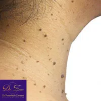 برداشتن خال و زگیل پوستی فقط 100
