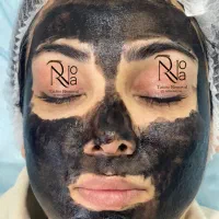 پاک کردن تتو با لیزر/ریموو ابرو/کربن تراپی(پزشک)|خدمات آرایشگری و زیبایی|مشهد, فردوسی|دیوار