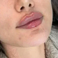 تزریق ژل لب روسی / مادلینگ و بوتاکس و فیلر بادی