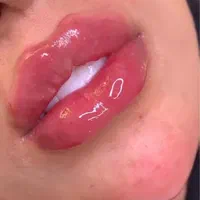تزریق ژل لب .زاویه فک . بوتاکس. فیلر چانه.|خدمات آرایشگری و زیبایی|تهران, تهرانپارس غربی|دیوار