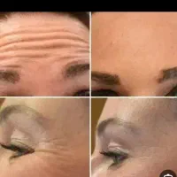 تزریق ژل و بوتاکس چربی فیلر|خدمات آرایشگری و زیبایی|بومهن, |دیوار