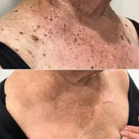 میکروبلیدینگ و لیزر تک جلسه کک ومک خال و تاتو