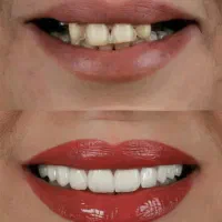 دندانپزشکی اقساطی ایمپلنت عصبکشی روکش لمینت و...