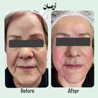 کانتورینگ با فیلر و ژل و لب تخصصی (کاملا طبیعی)|خدمات آرایشگری و زیبایی|مشهد, گلبرگ شمالی|دیوار